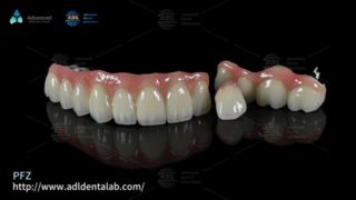 Korony dentystyczne PFZ Naturalna wytrzymałość i precyzyjne dopasowanie