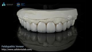 Licówki ceramiczne skaleniowe o wysokiej przezroczystości do uśmiechu