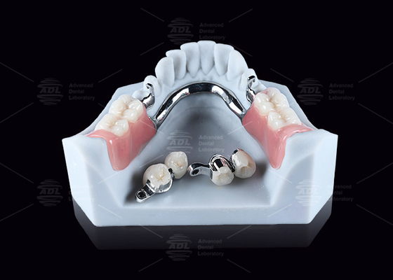 kupować CEKA M2 Precision Attachment Titanium Z 3mm Horizontal / Vertical Clearances produkcja online