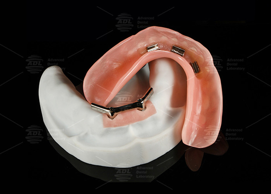 kupować Zestaw tytanowy, sznap na Dolder Implant Bar Overdenture Polerowany dla naturalnego uśmiechu produkcja online