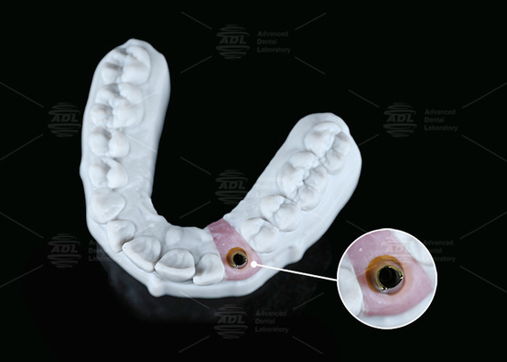 kupować Wewnętrzny sześciokątny Titanium Custom Abutment Screw Cement Zachowany Zmienny kształt produkcja online