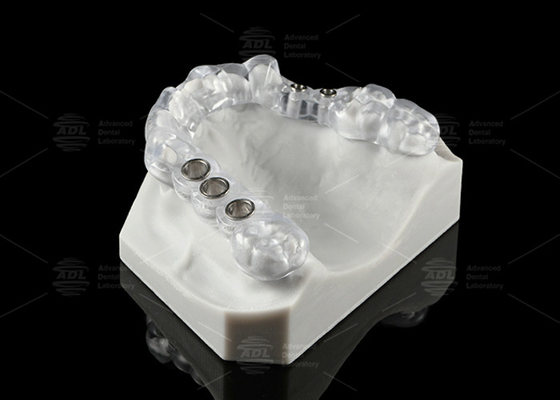 kupować Specjalnie wykonane przezroczyste implanty stomatologiczne Stent chirurgiczny Ergonomiczny projekt produkcja online