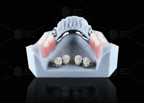 kupować Tytanowy implant stomatologiczny przymocowanie piłki wygodne bezpieczne utrzymanie protezy produkcja online