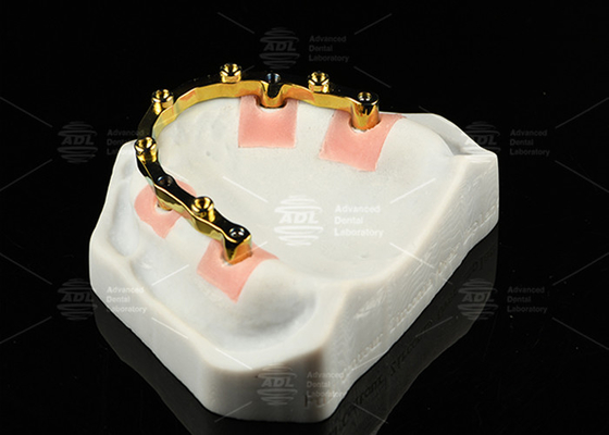 kupować Tytanowy sztab lokalizatora implantów z piaskowaniem Srebrny złoty wkład lokalizatora implantów dentystycznych produkcja online