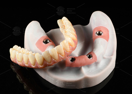 Kompozytywna różowa korona porcelanowa A1 Shade All On 4 Hybrid Titanium Screw Retained