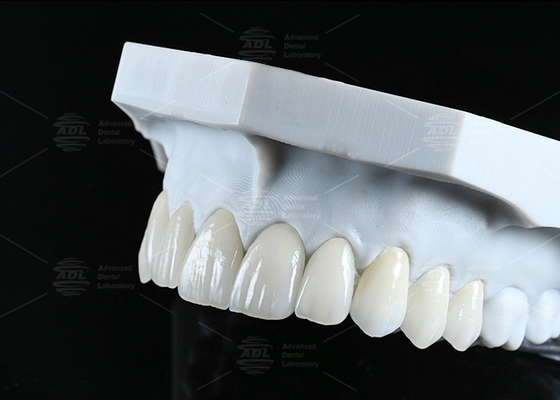 Translucency CAD EMAX Veneer Polerowane Szklane Ceramiczne Restauracje Do Przodu Poza