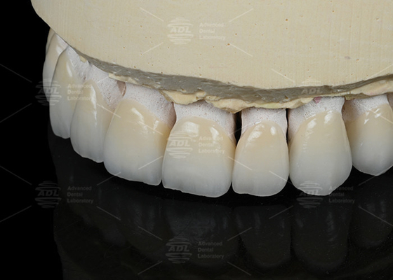 Naturalny kolor zębów Ceramic Feldspathic Veneer dla przednich i tylnych zębów