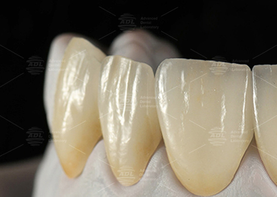 0.3mm-0.7mm Feldspatic EMAX Ceramic Veneers Natural Aesthetic Emax Dental Veneers
