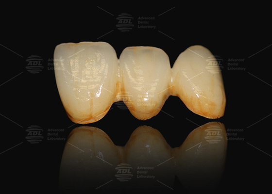 A3 A3.5 Porcelana stopiona do metalu i ceramiki PFM Cad Cam