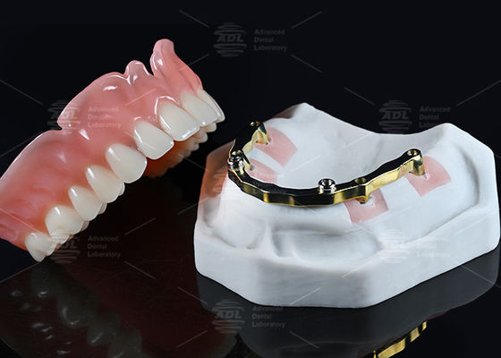 Chiny Dental Lab Titanium Lokator Przymocowanie z pełnym akrylem nad protezą