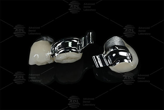 Chiński Laboratorium Protetyczne Regulowany Pacjent Specyficzny Kanał Kluczowy Precyzyjny Element Połączeniowy z PFM