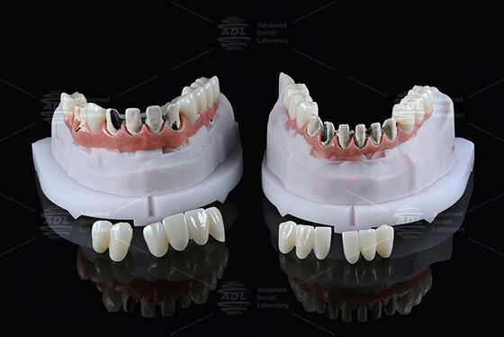 Chińska protetyka stomatologiczna: Tytanowy most hybrydowy pełnego łuku, z natychmiastowym obciążeniem, odcień A1, projekt Malong, przykręcany, CAD/CAM