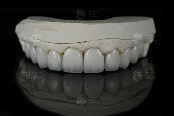 0.3mm-0.7mm Feldspatic EMAX Ceramic Veneers Natural Aesthetic Emax Dental Veneers