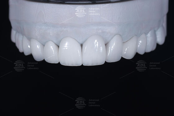Translucency CAD EMAX Veneer Polerowane Szklane Ceramiczne Restauracje Do Przodu Poza
