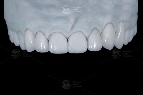 Naturalny kolor zębów Ceramic Feldspathic Veneer dla przednich i tylnych zębów